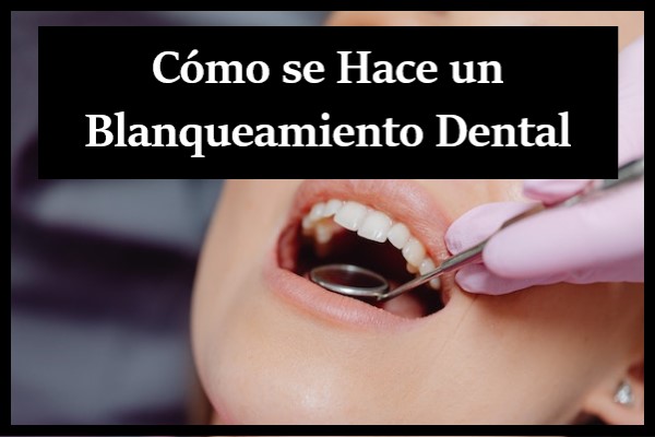 como se hace un blanqueamiento dental